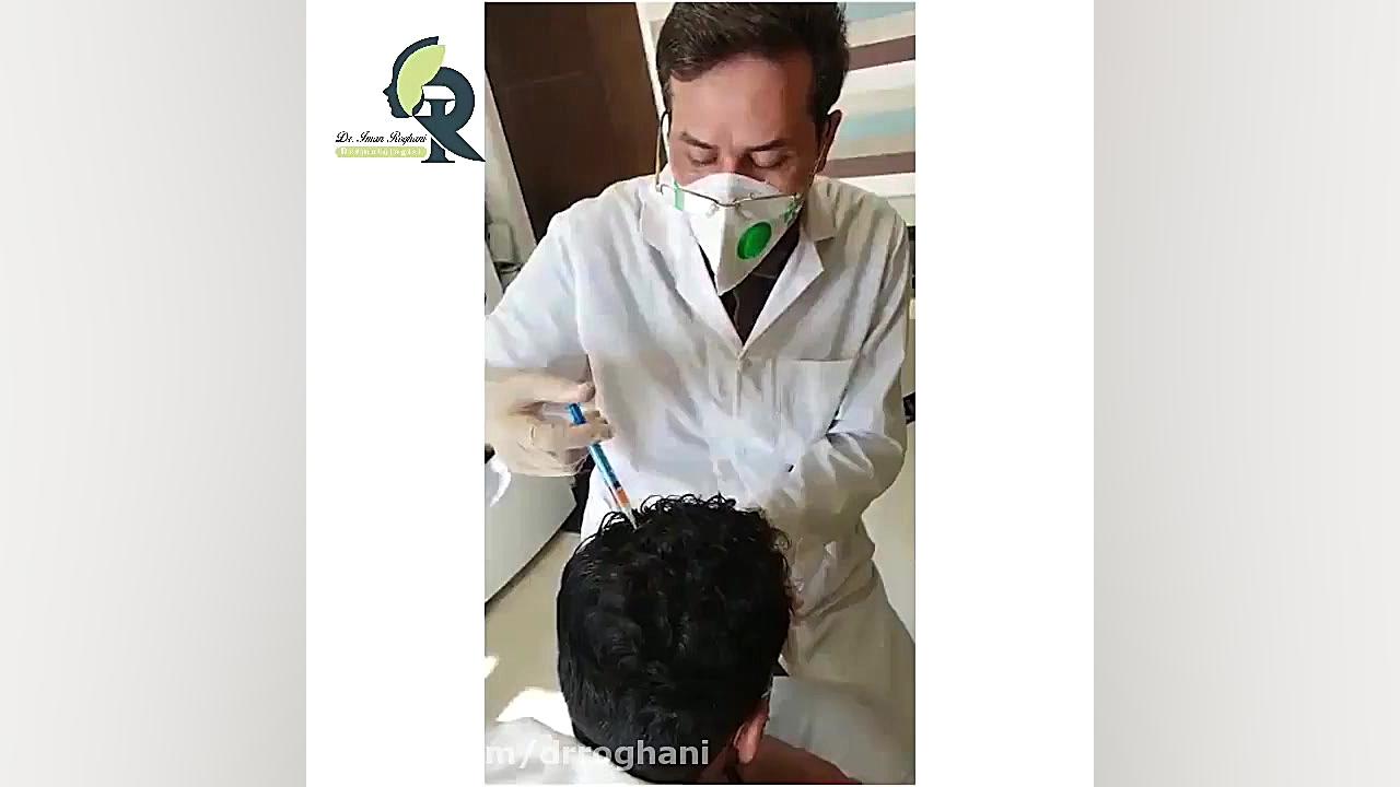 تزریق پی آر پی برای کنترل ریزش مو دکتر ایمان روغنی جراح و متخصص پوست و مو