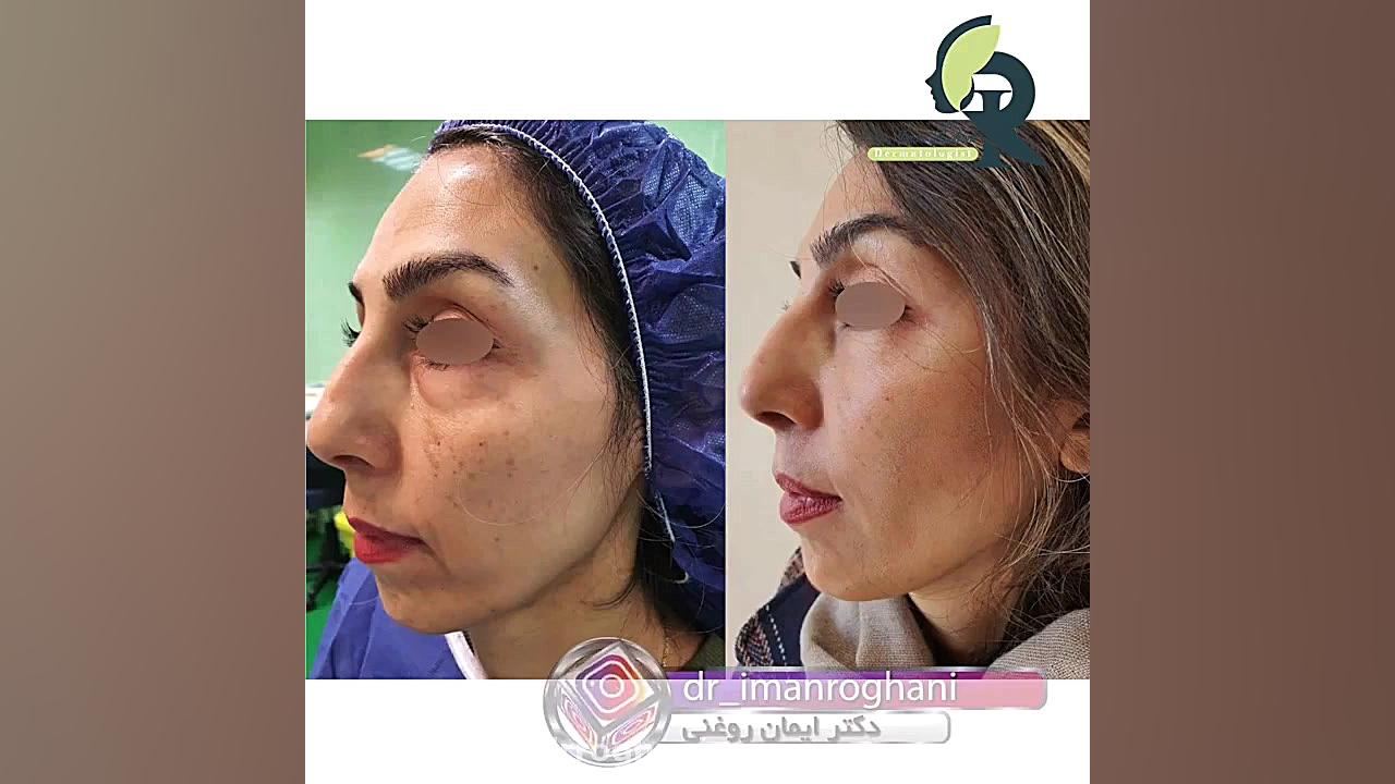 تزریق چربی جهت ریمودلینگ صورت دکتر ایمان روغنی جراح و متخصص پوست و مو