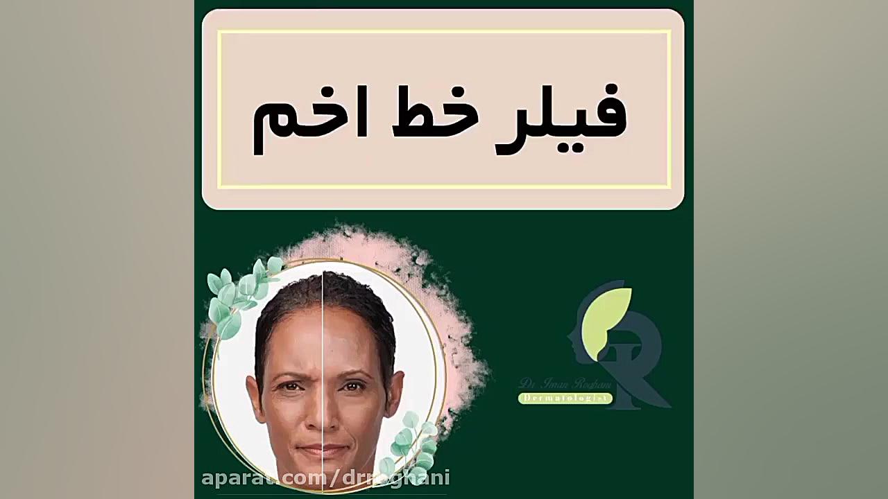 فیلر خط اخم دکتر ایمان روغنی جراح و متخصص پوست و مو