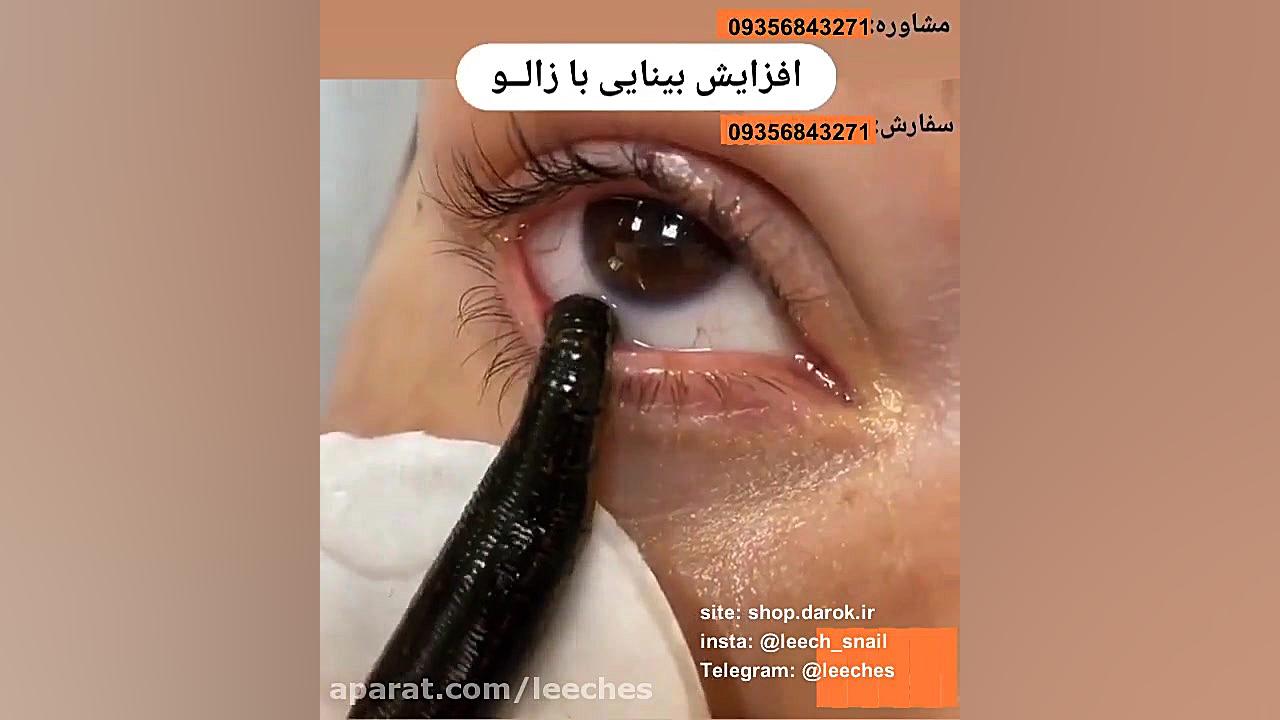 زالو درمانی بینایی یوتیوب