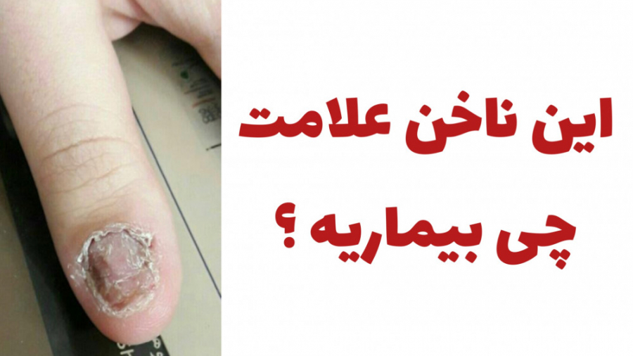 تغییرات ناخن