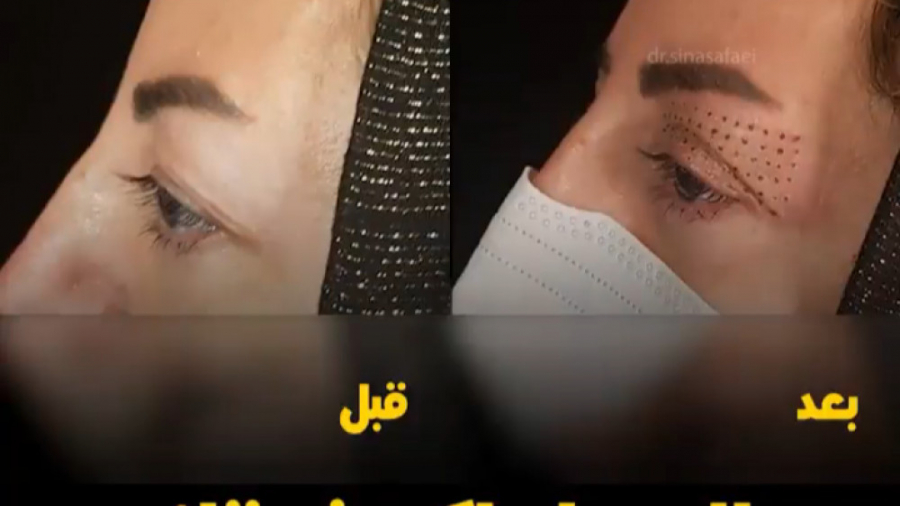 پلاسما پلک فوقانی پزشکی دریایی