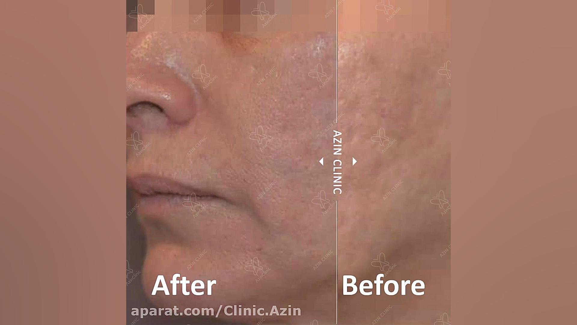 درمان جای جوش صورت جراحی پف زیر چشم