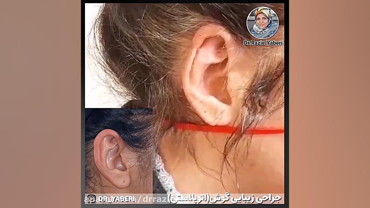 جراحی گوش یا اتوپلاستی پریودنتیکس