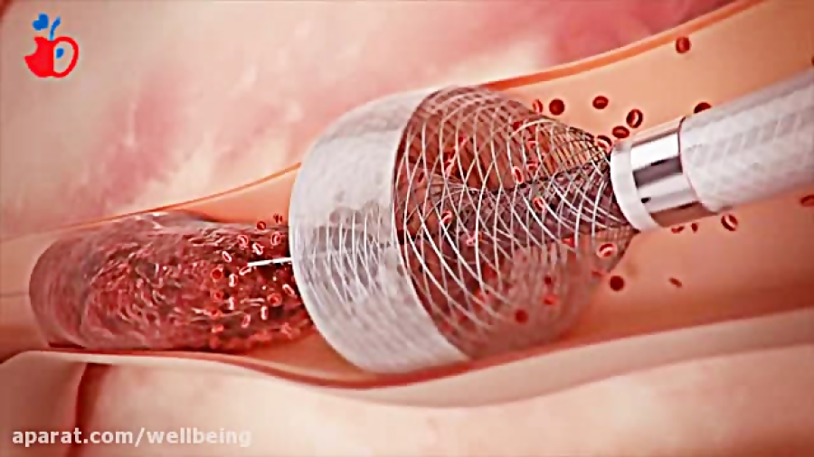 آنژیوگرافی قلب با سیستم ترومبکتومی پالپوتومی