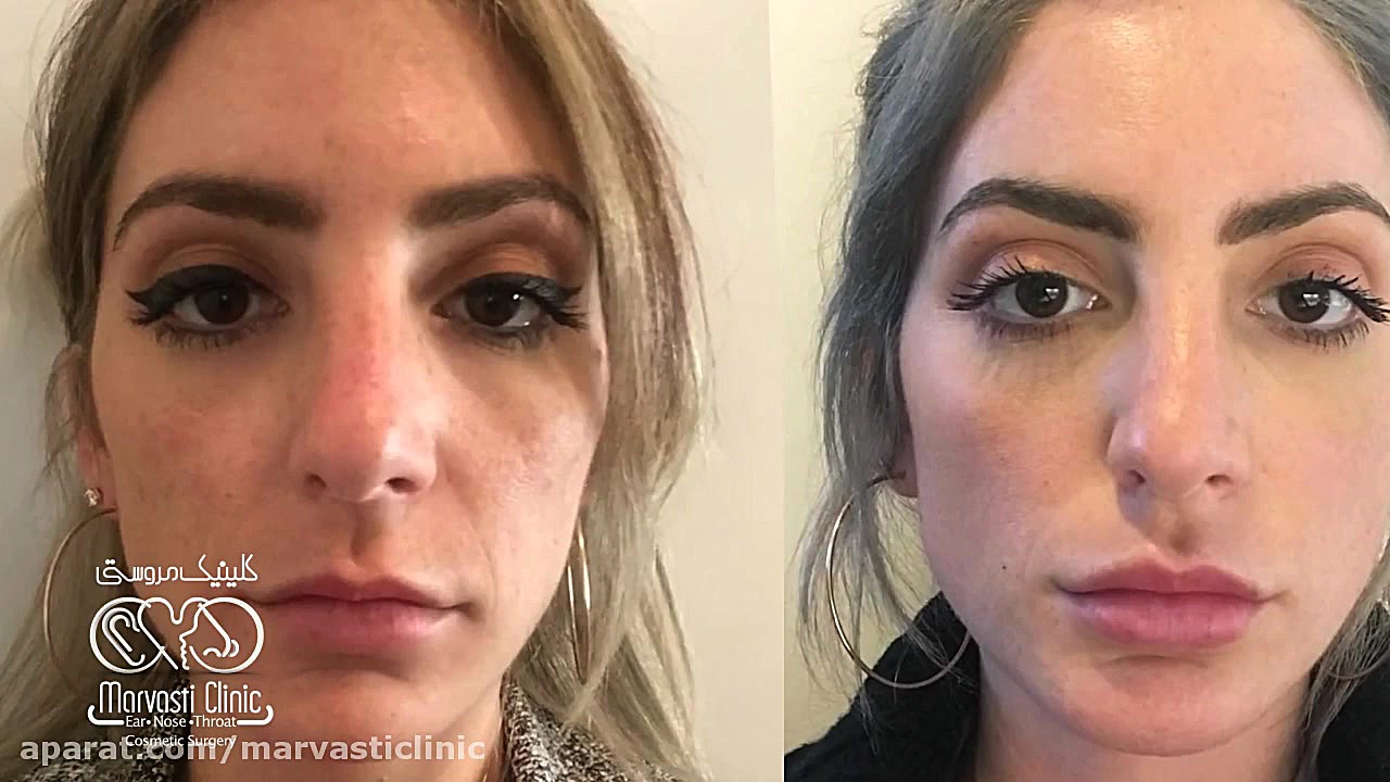 میکرونیدلینگ و جوانسازی پوست صورت جراحی فک