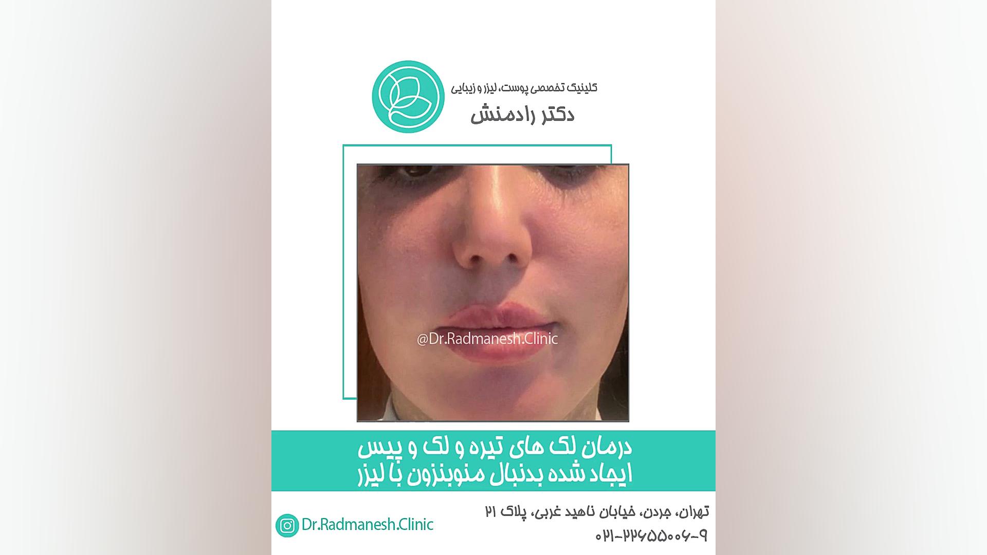 درمان لک های تیره و لک و پیس ایجاد شده بدنبال منوبنزون با لیزر ارتودنسی