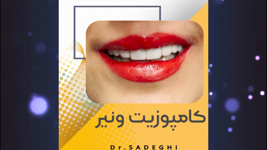 کامپوزیت ونیر در شمال تهران - 10 درصد تخفیف از وب سایت ساکوبیتریل