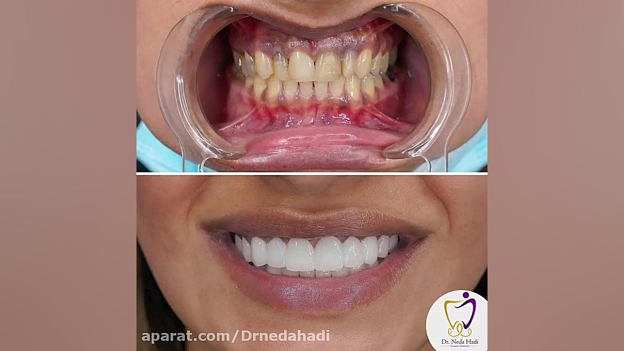 فیلم واقعی لمینت دندان دکتر ندا هادی-دندانپزشک زیبایی