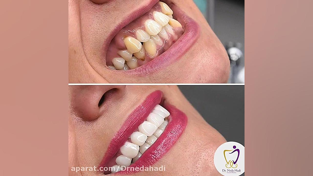 انجام کامپوزیت دندان توسط دکتر ندا هادی دکتر ندا هادی-دندانپزشک زیبایی