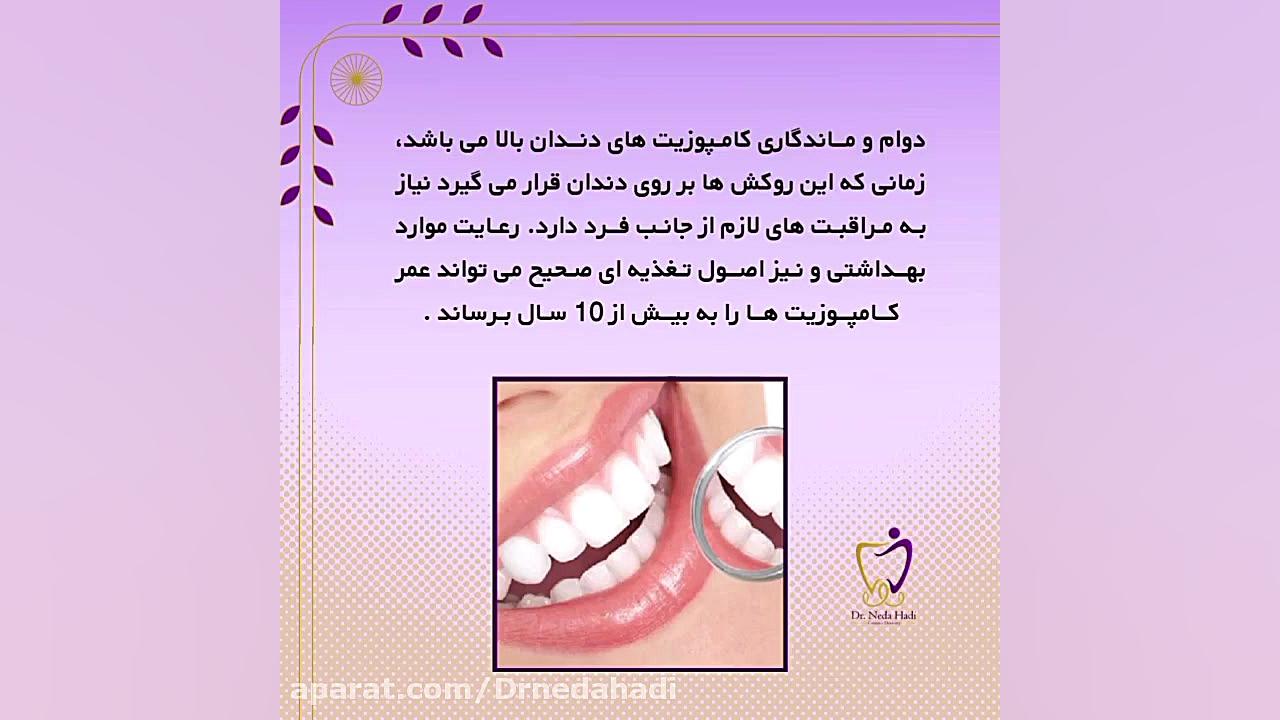 کامپوزیت دندان چقدر ماندگاری دارد؟ دکتر ندا هادی-دندانپزشک زیبایی