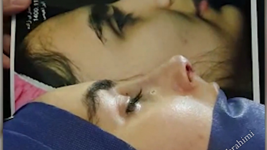 عمل بینی توسط دکتر امید ابراهیمی بهترین جراح بینی تهران دکتر امید ابراهیمی