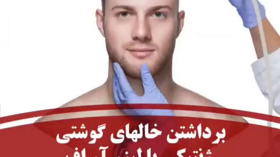 برداشتن خالهای گوشتی ژنتیکی با لیزر آر اف دکتر بهزاد انوش|متخصص و جراح پوست مو زیبایی و لیزر