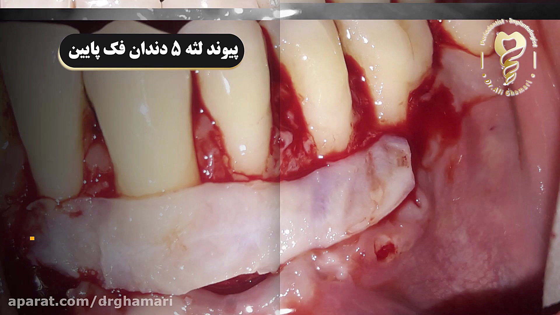 فیلم جراحی پیوند لثه 5 دندان فک پایین دکتر علی قمری - متخصص جراحی لثه و ایمپلنت