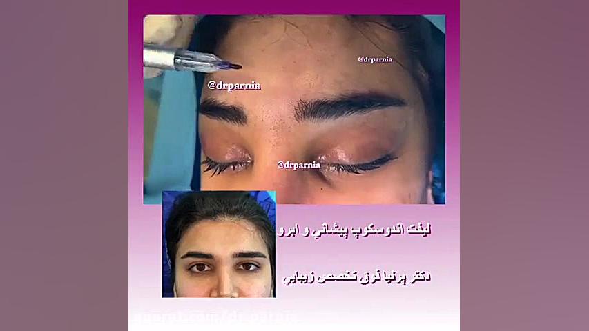 لیفت آندوسکوپ پیشانی پیلینگ شیمیایی