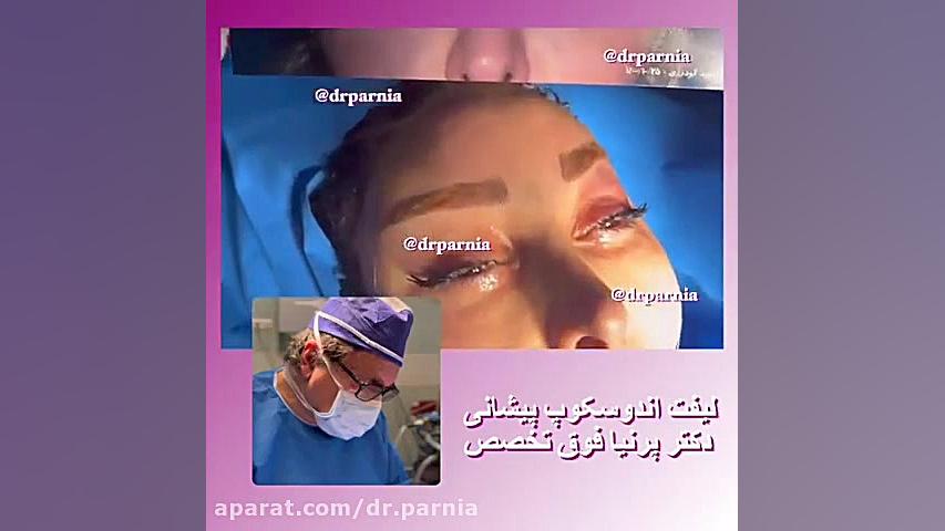لیفت آندوسکوپ پیشانی دکتر رفیع پرنیا فوق تخصص پلاستیک