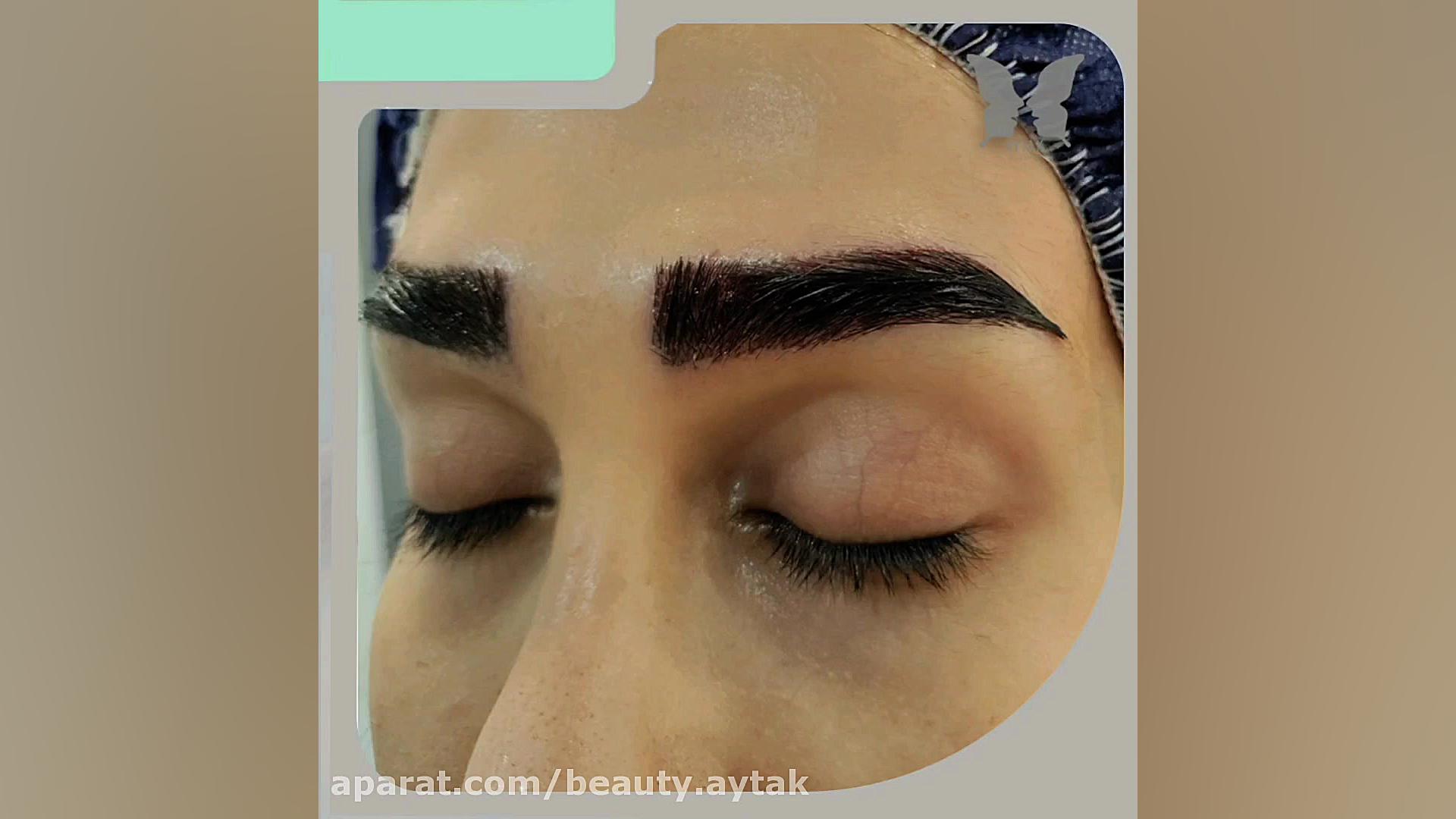 فیلم پیوند ابرو طبیعی | مرکز کاشت آیتک | جراحی لثه