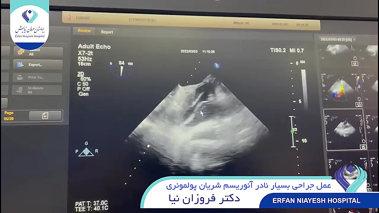 فیلم جراحی آنوریسم شریان پولمونری اصلاح فرم صورت