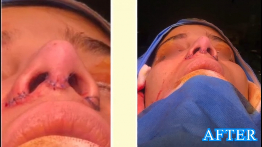 فیلم واقعی عمل بینی دکتر حمید رضا فتحی فوق تخصص جراحی پلاستیک