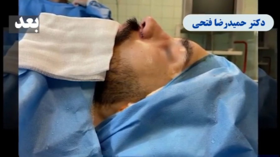 فیلم اتاق عمل جراحی بینی مردانه دکتر حمید رضا فتحی فوق تخصص جراحی پلاستیک