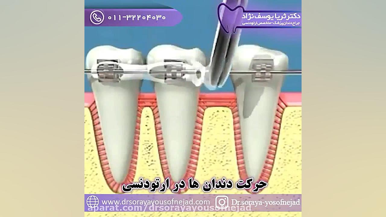 حرکت دندان ها در ارتودنسی دکتر ثریا یوسف نژاد متخصص ارتودنسی بابل