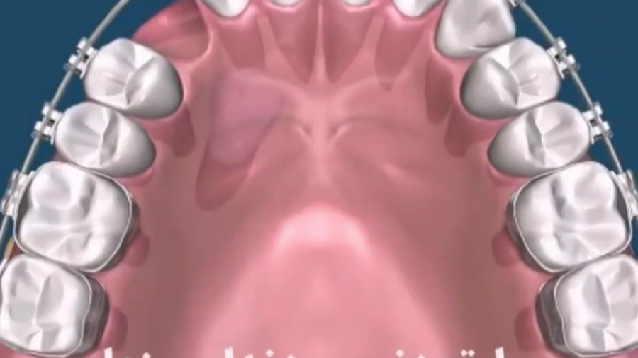 ارتودنسی دندان پنهان دکتر ثریا یوسف نژاد متخصص ارتودنسی بابل