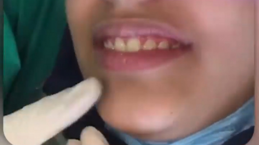 نتیجه ارتودنسی دندان توسط دکتر یوسف نژاد دکتر ثریا یوسف نژاد متخصص ارتودنسی بابل