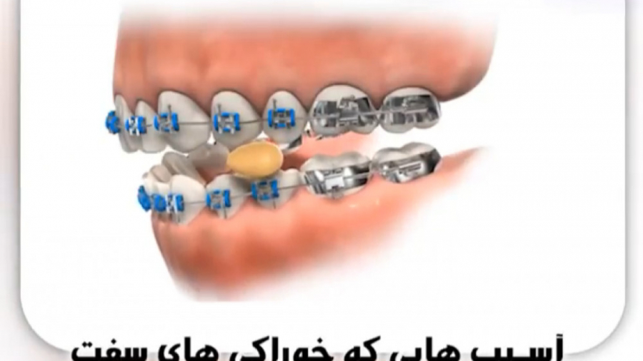 آسیب هایی که خوراکی های سفت به ارتودنسی می زنند دکتر ثریا یوسف نژاد متخصص ارتودنسی بابل