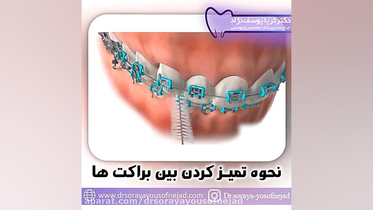 نحوه تمیز کردن بین براکت های ارتودنسی دکتر ثریا یوسف نژاد متخصص ارتودنسی بابل