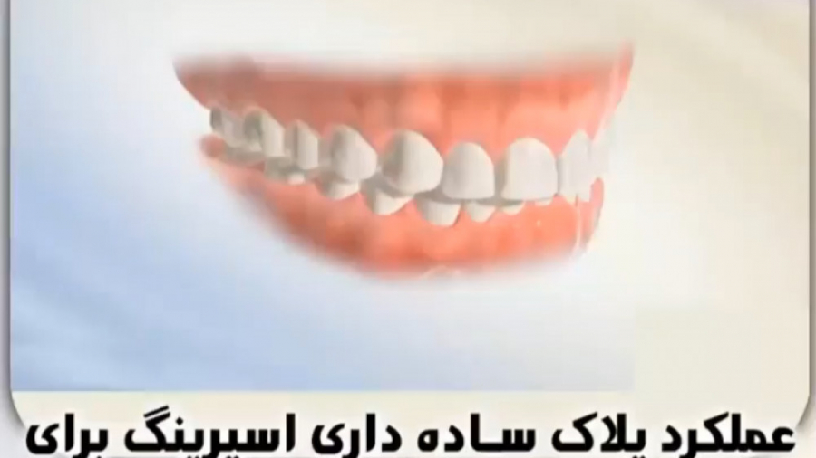 عملکرد پلاک ساده دارای اسپرینگ دکتر ثریا یوسف نژاد متخصص ارتودنسی بابل