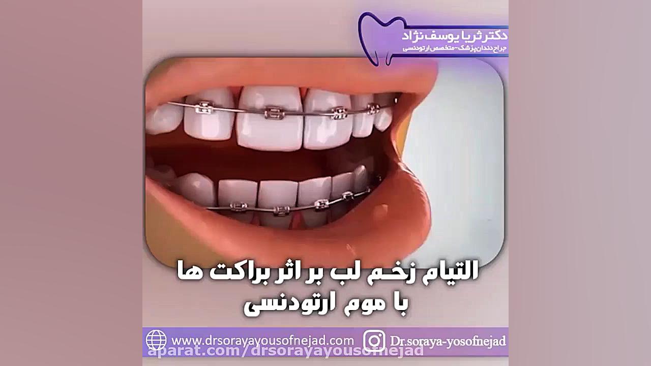 التیام زخم لب بر اثر براکت ها با موم ارتودنسی دکتر ثریا یوسف نژاد متخصص ارتودنسی بابل