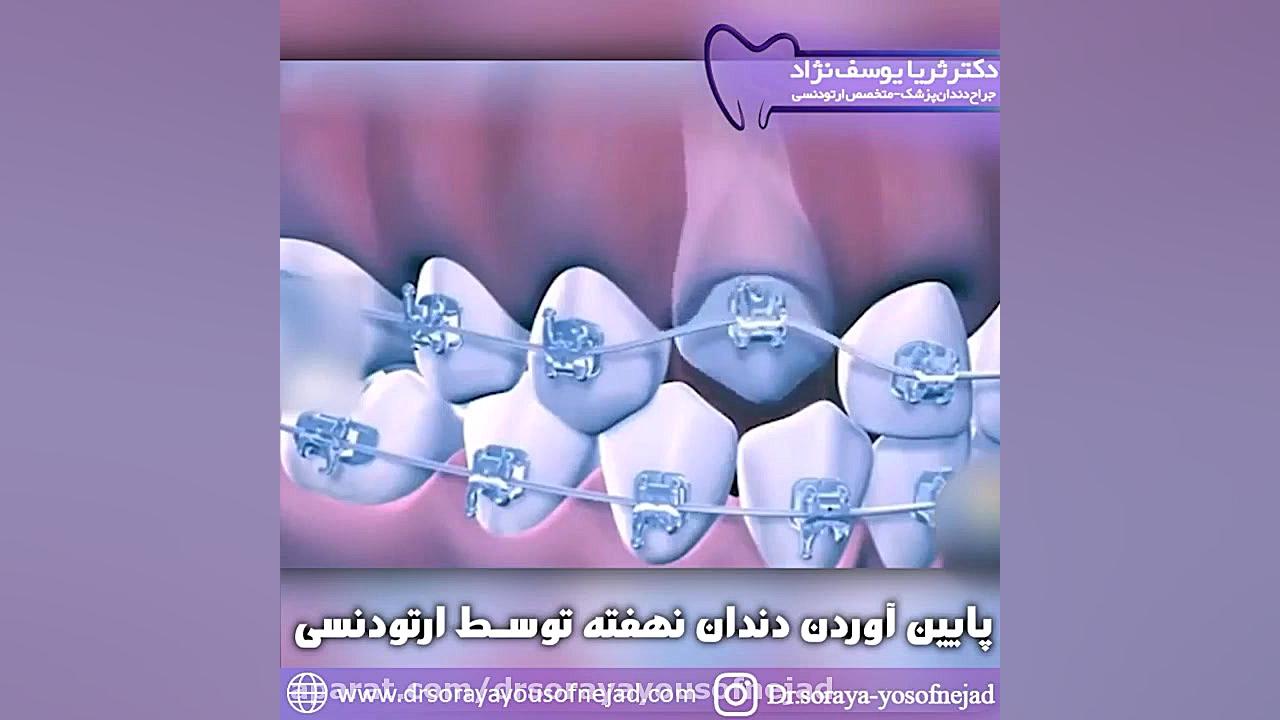 پایین آوردن دندان نهفته با ارتودنسی دکتر ثریا یوسف نژاد متخصص ارتودنسی بابل