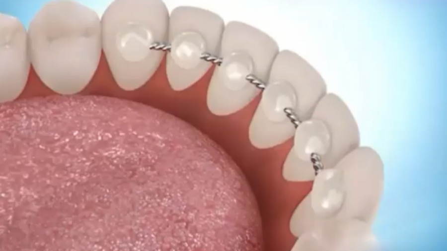 نحوه نخ کشیدن در زیر نگهدارنده های دائم دکتر ثریا یوسف نژاد متخصص ارتودنسی بابل