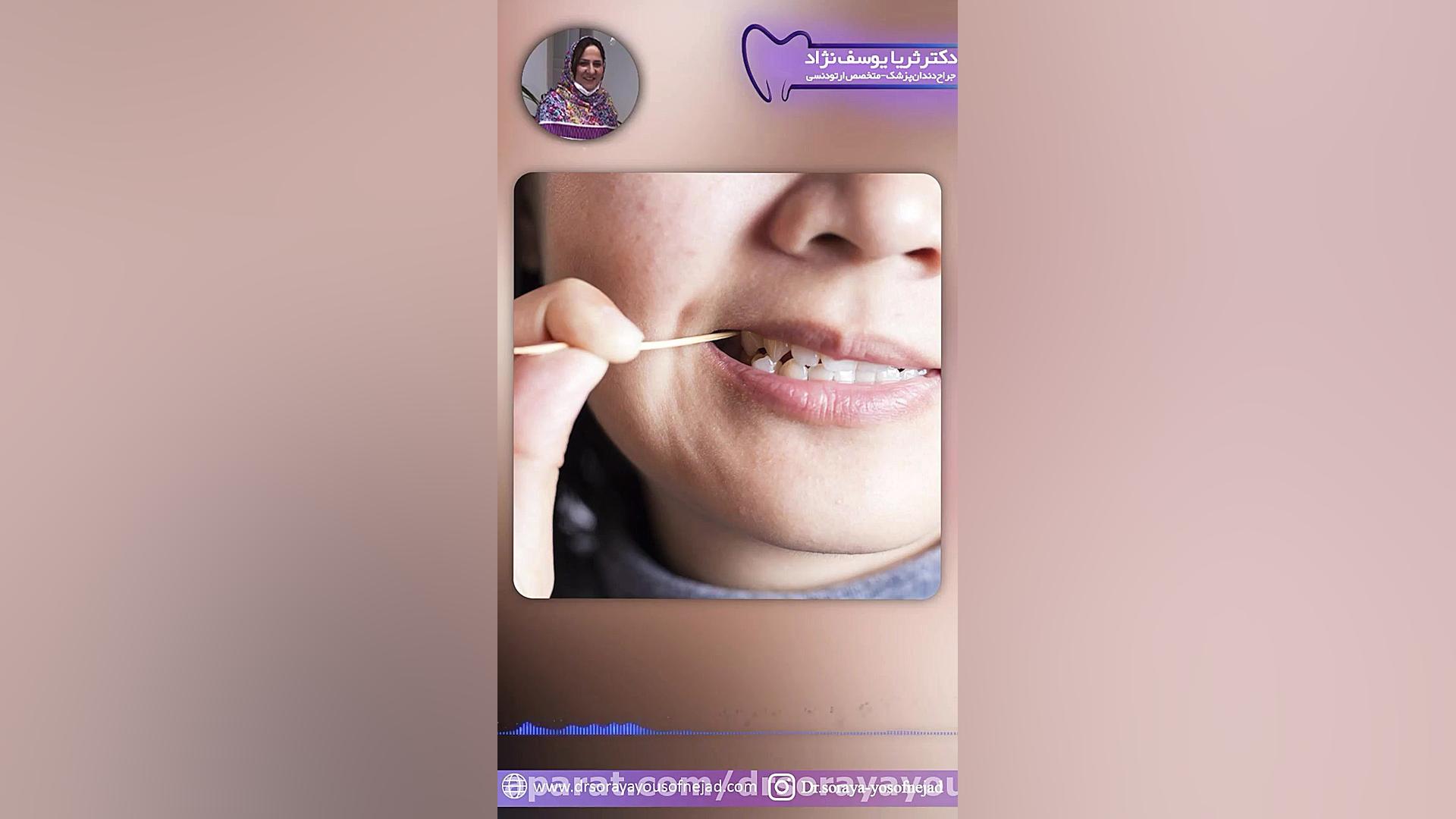 چه موقع میتوانیم ونیر کامپوزیت انجام دهیم ؟ دکتر ثریا یوسف نژاد متخصص ارتودنسی بابل