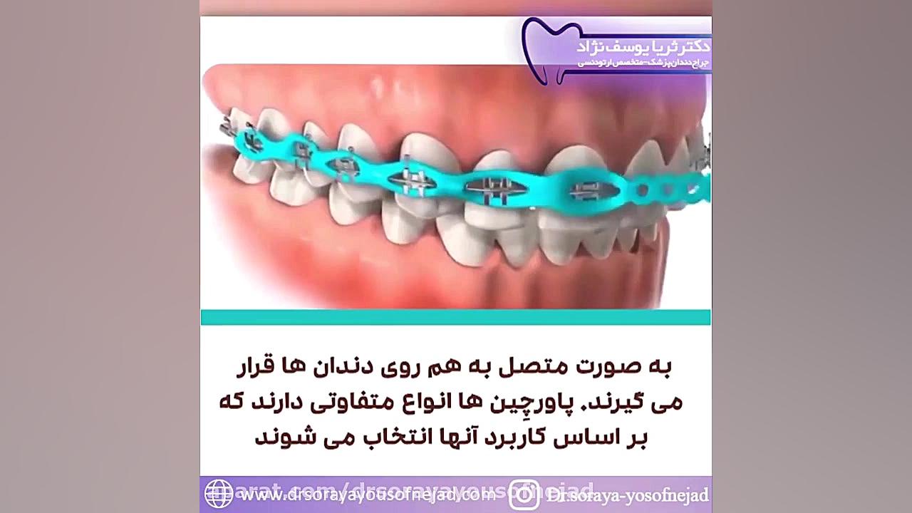 پاورچِین ( power chains ) دکتر ثریا یوسف نژاد متخصص ارتودنسی بابل