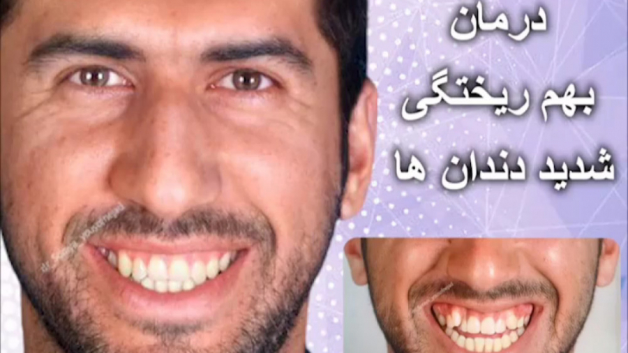 درمان بهم ریختگی شدید دندان ها دکتر ثریا یوسف نژاد متخصص ارتودنسی بابل