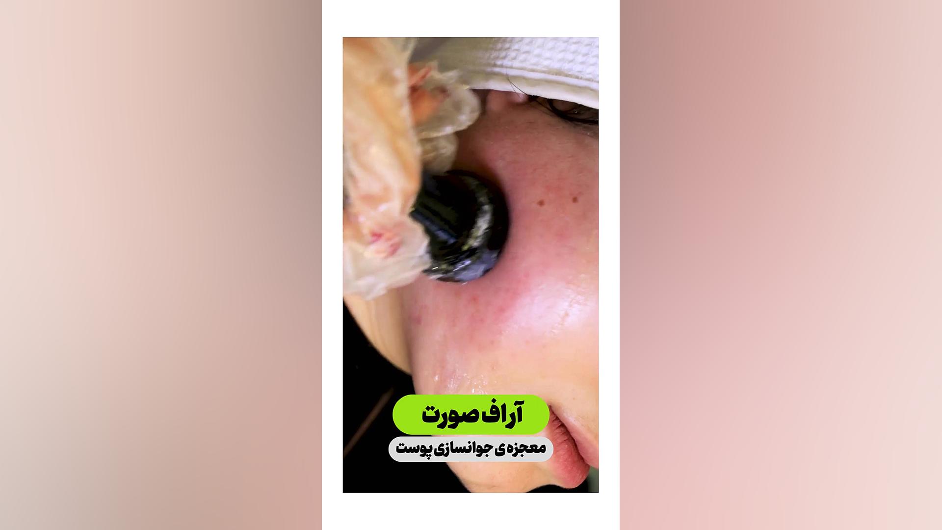 جوانسازی پوست با آر اف بیماری آلبینیزم اوکولوتئوکوتانئوس