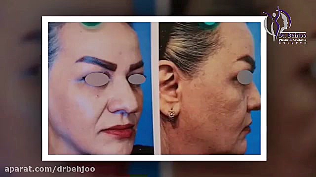 جراحی بینی طبیعی دکتر شاهین بهجو - فوق تخصص جراحی پلاستیک
