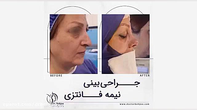 توصیه می کنیم فیلم جراحی بینی نیمه فانتزی را ببینید! دکتر شاهین بهجو - فوق تخصص جراحی پلاستیک