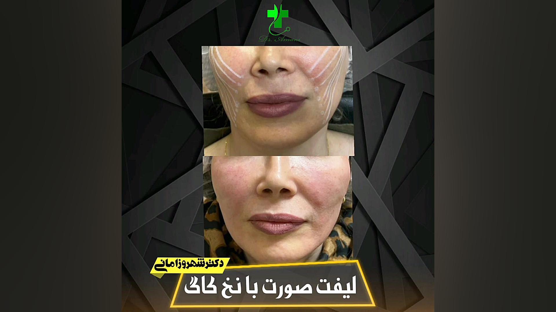 لیفت صورت با نخ کاگ دکترشهروز امانی سنسور فشار اینتراوسکولار