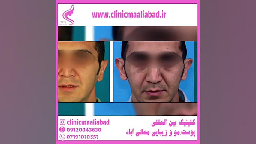 جراحی گوش برجسته یا لیفت گوش چیست ؟ ANCA