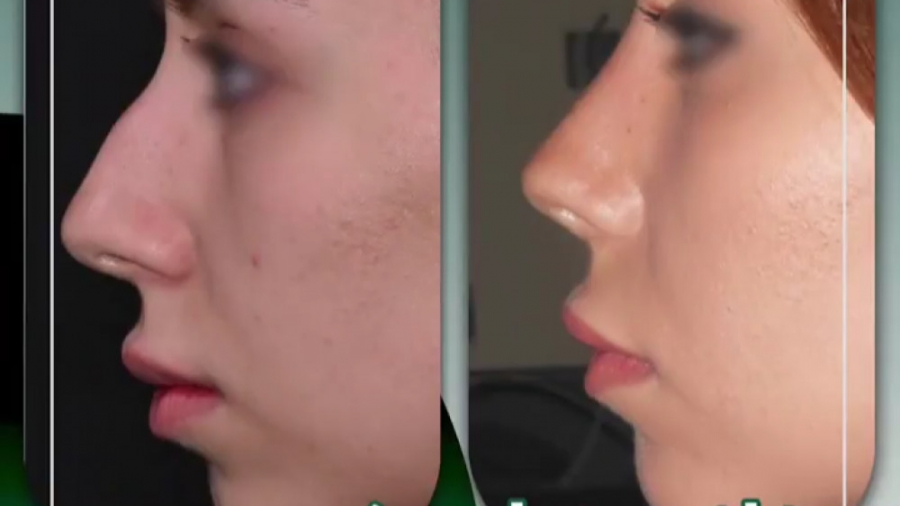 جراحی زیبایی بینی دکتر محمدرضا آخوندی نسب-فوق تخصص جراحی پلاستیک