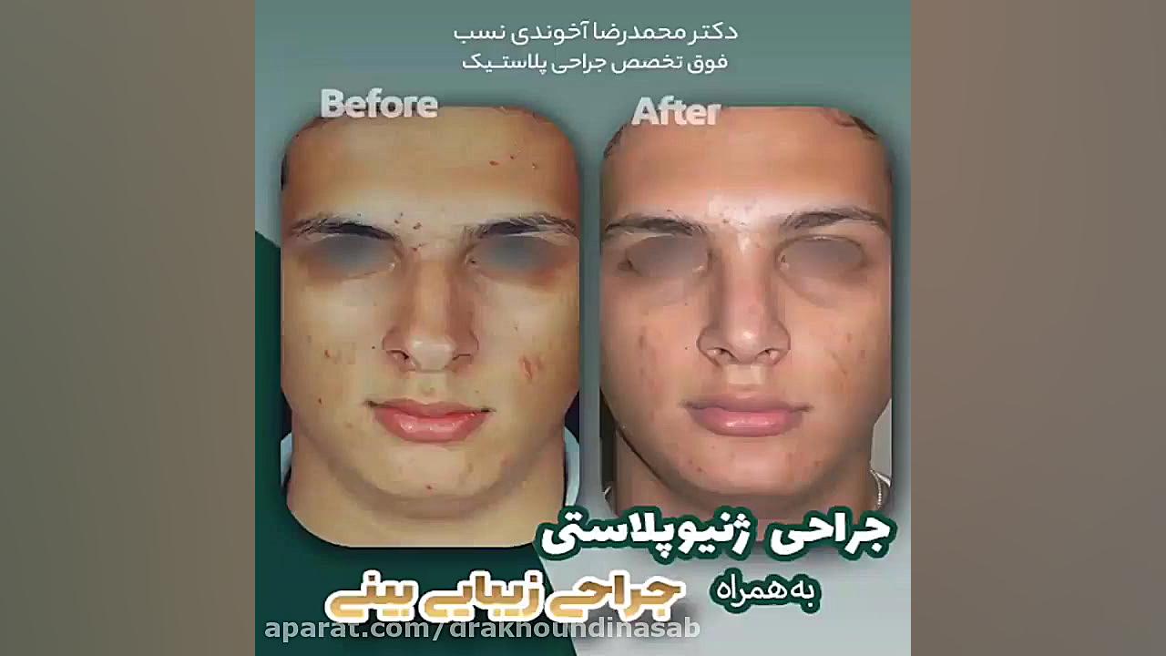 جراحی ژنیوپلاستی به همراه جراحی زیبایی بینی دکتر محمدرضا آخوندی نسب-فوق تخصص جراحی پلاستیک