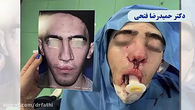 فیلم اتاق عمل جراحی بینی مردانه دکتر حمید رضا فتحی فوق تخصص جراحی پلاستیک