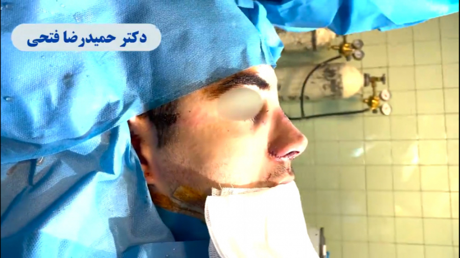 فیلم اتاق عمل جراحی بینی مردانه دکتر حمید رضا فتحی فوق تخصص جراحی پلاستیک