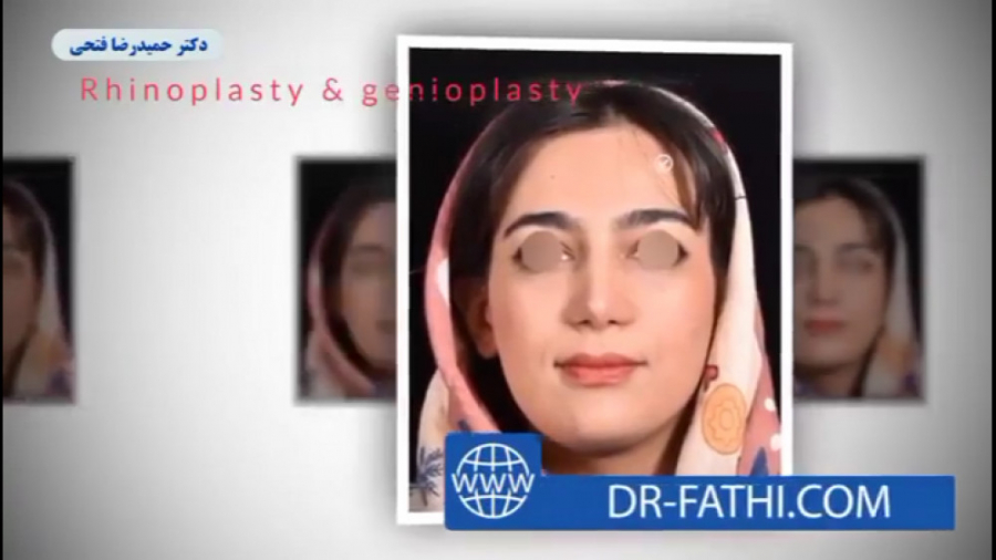 عمل جراحی زیبایی بینی دکتر حمید رضا فتحی فوق تخصص جراحی پلاستیک
