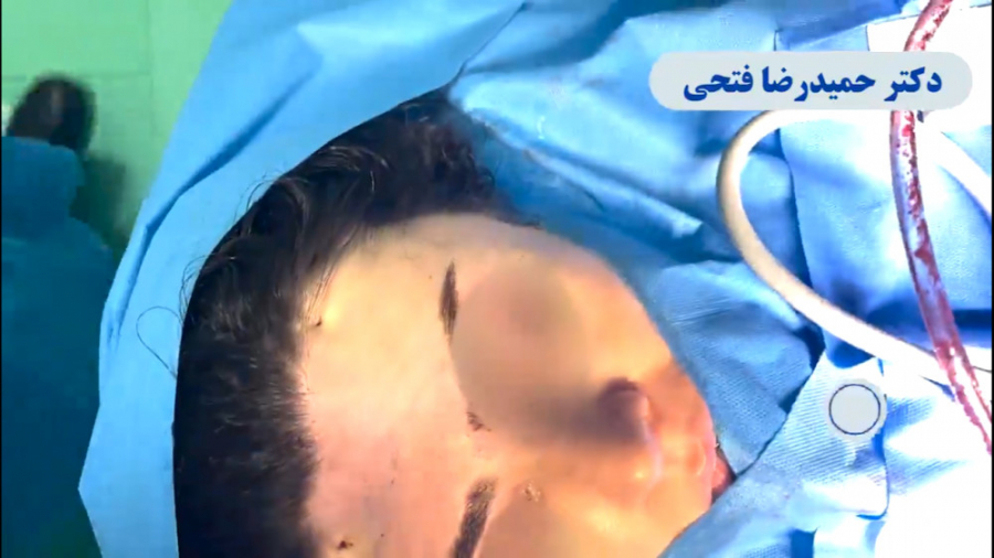 لیفت آندوسکوپی صورت دکتر حمید رضا فتحی فوق تخصص جراحی پلاستیک