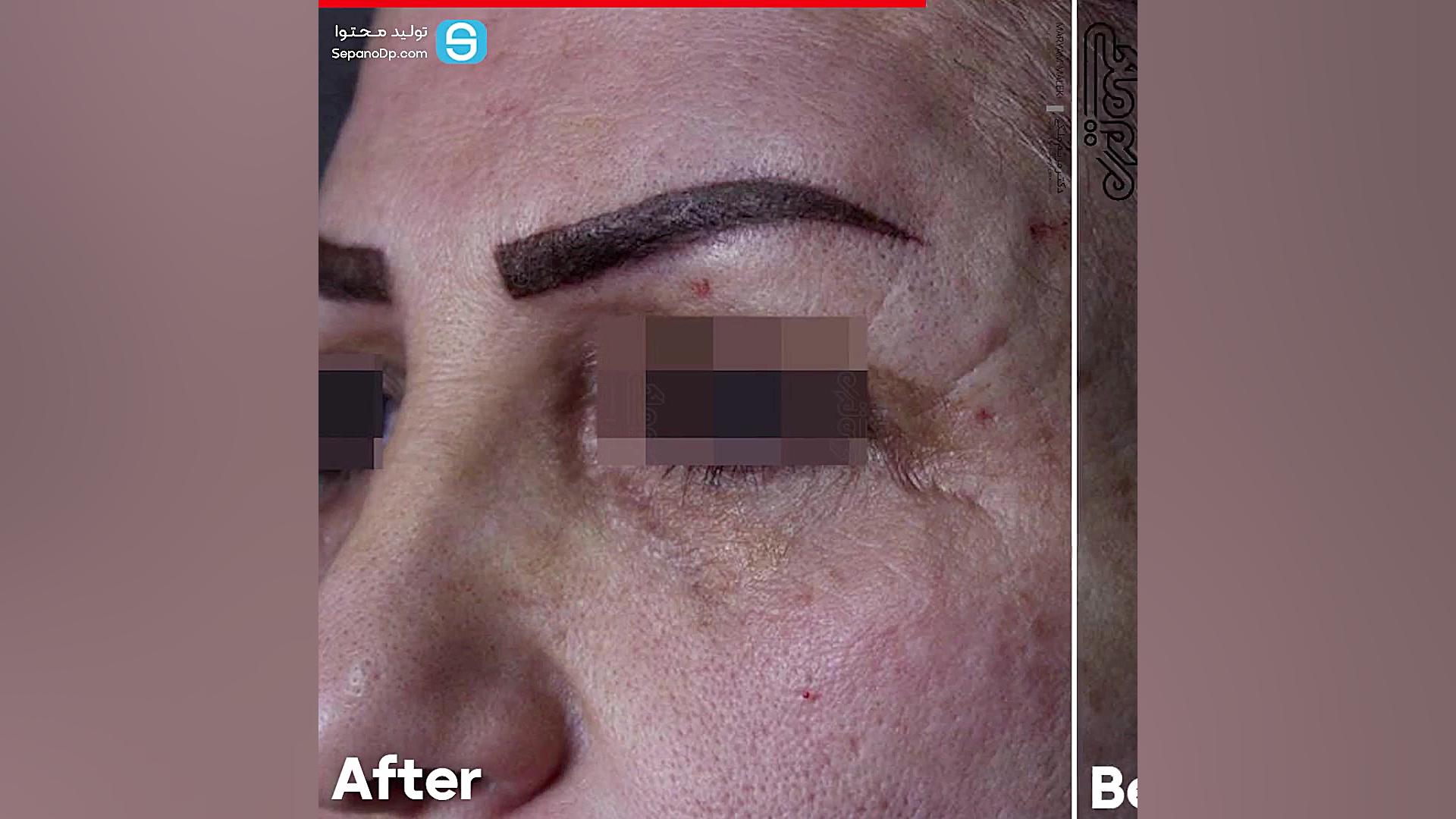 بلافاصله پس از تزریق ژل زیر چشم دکتر مریم ملکی - کلینیک پوست و مو و زیبایی هور