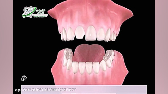 آماده سازی تاج دندان آسیب دیده - ترمیم Organoid Viability Test