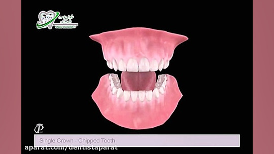 تاج تنها ، دندان رنده - ترمیم RF Test